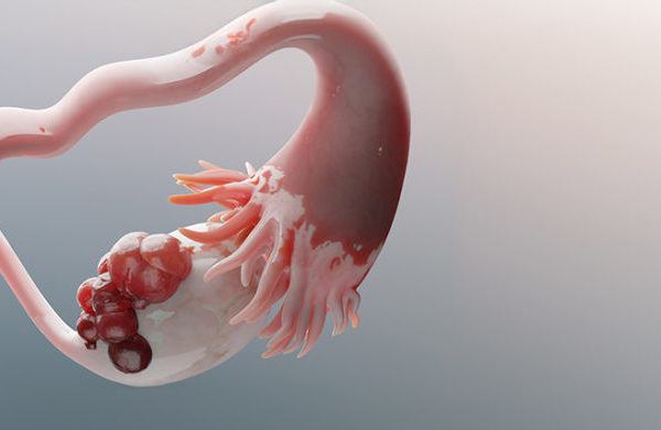 Endometriosis: The Real Cause of Dysmenorrhea