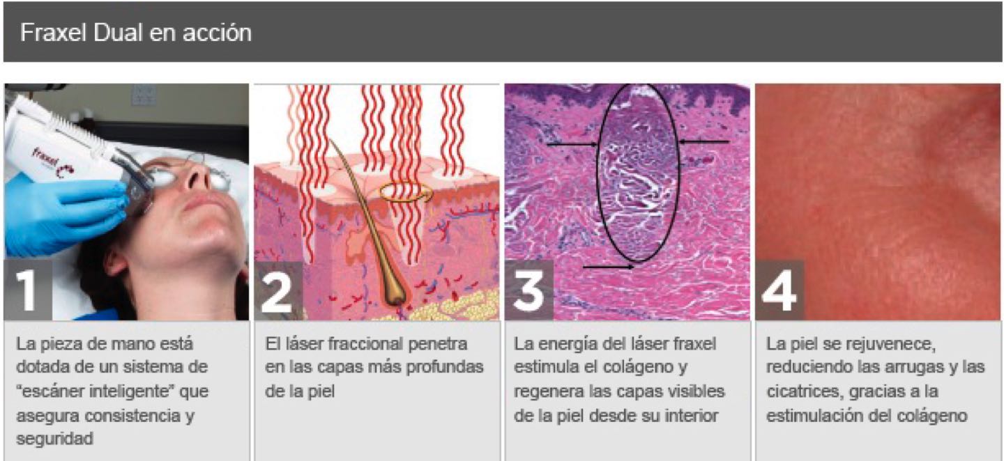 láser rejuvenecimiento vaginal 