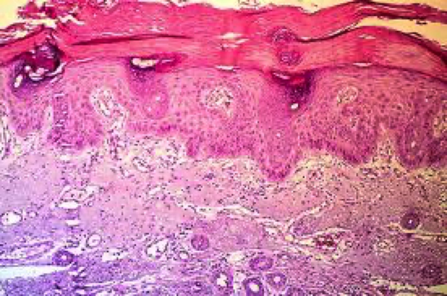 cáncer de piel